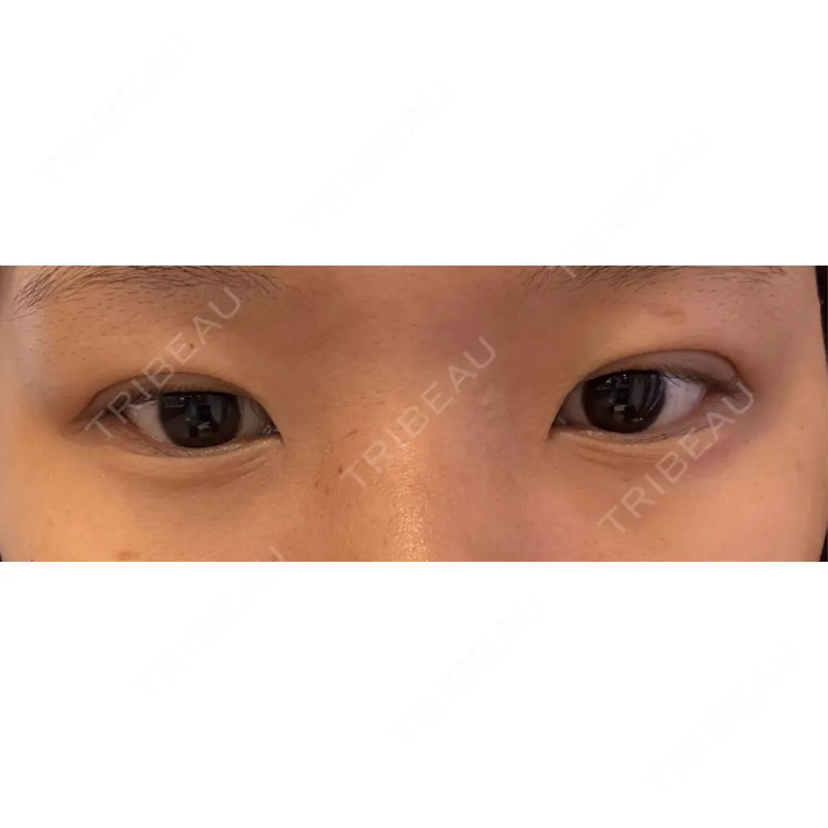 二重埋没 NARU Beauty Clinic 【ナルクリ】 DAY 0