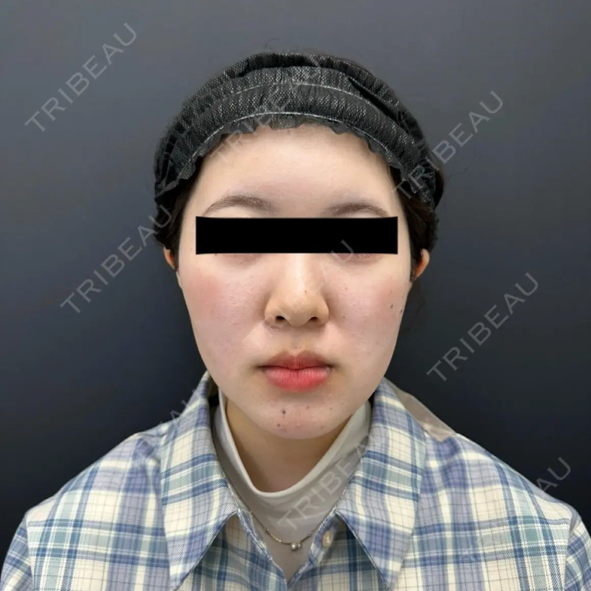 糸リフト / 脂肪吸引（顔） BLINC CLINIC （ブリンク クリニック） AFTER