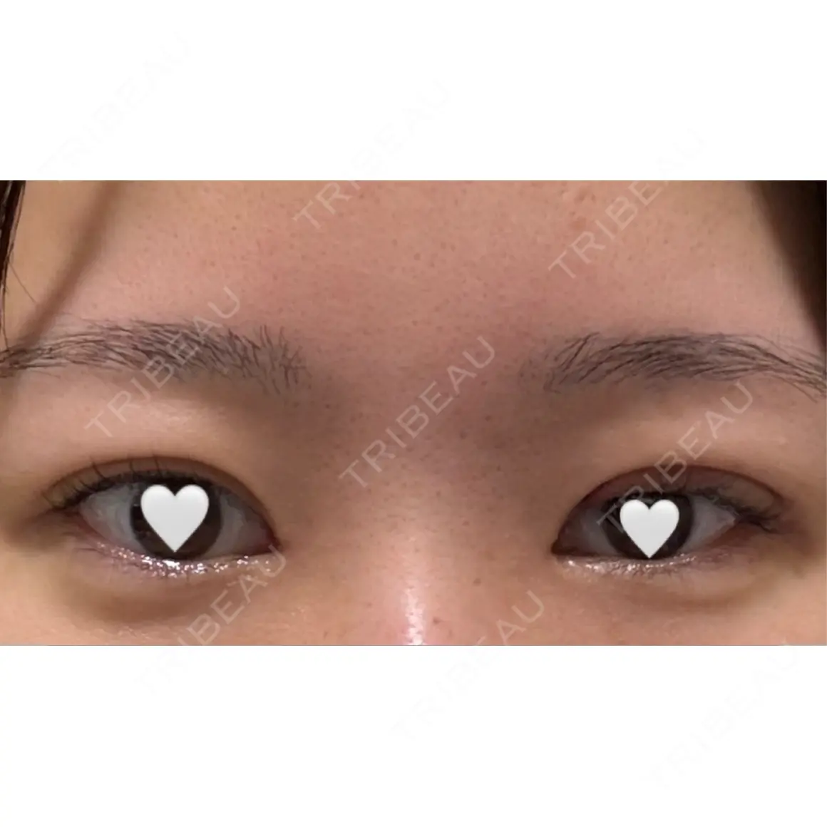 二重埋没 / 目頭切開 / その他（目元） 9BeautyClinic AFTER