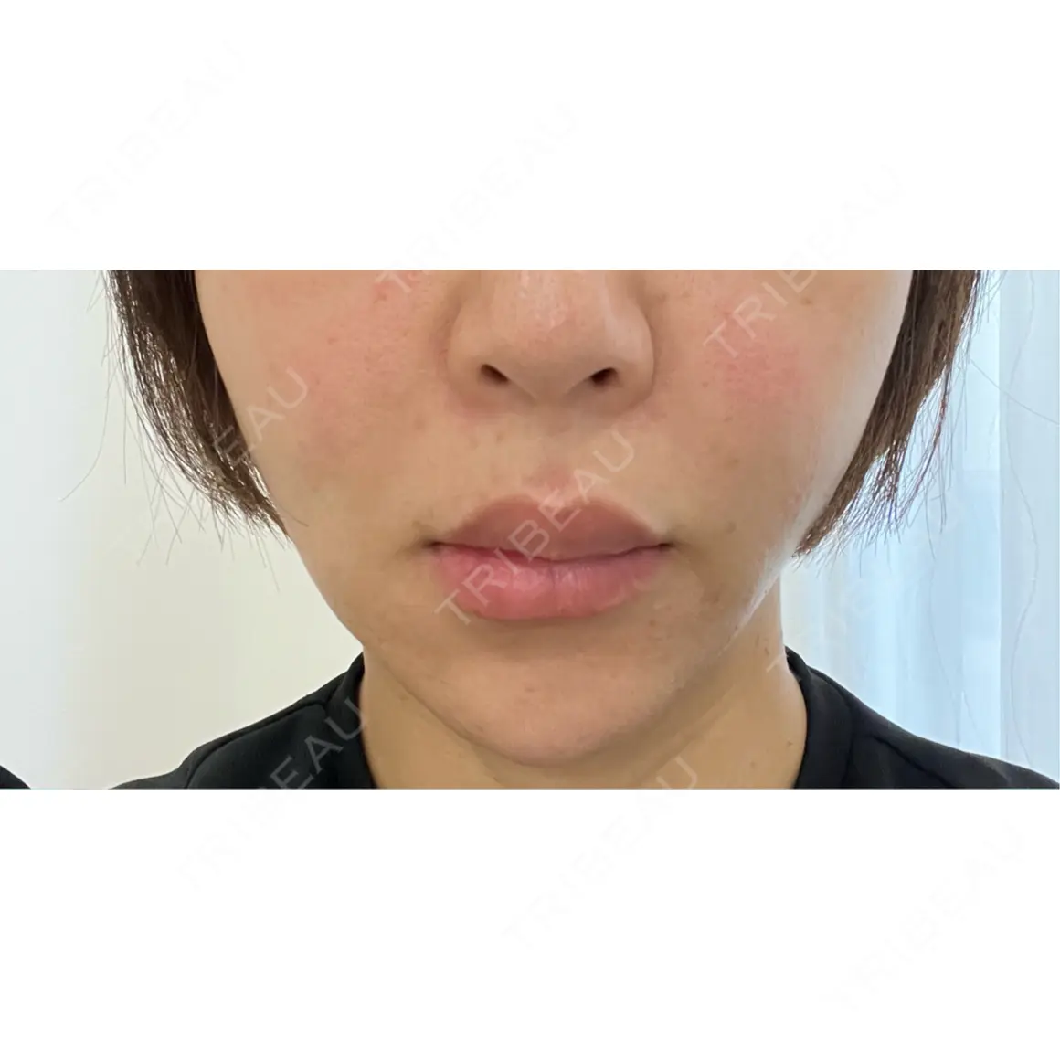 イオン導入 / ルメッカ Grias clinic （ジリアスクリニック） DAY 1