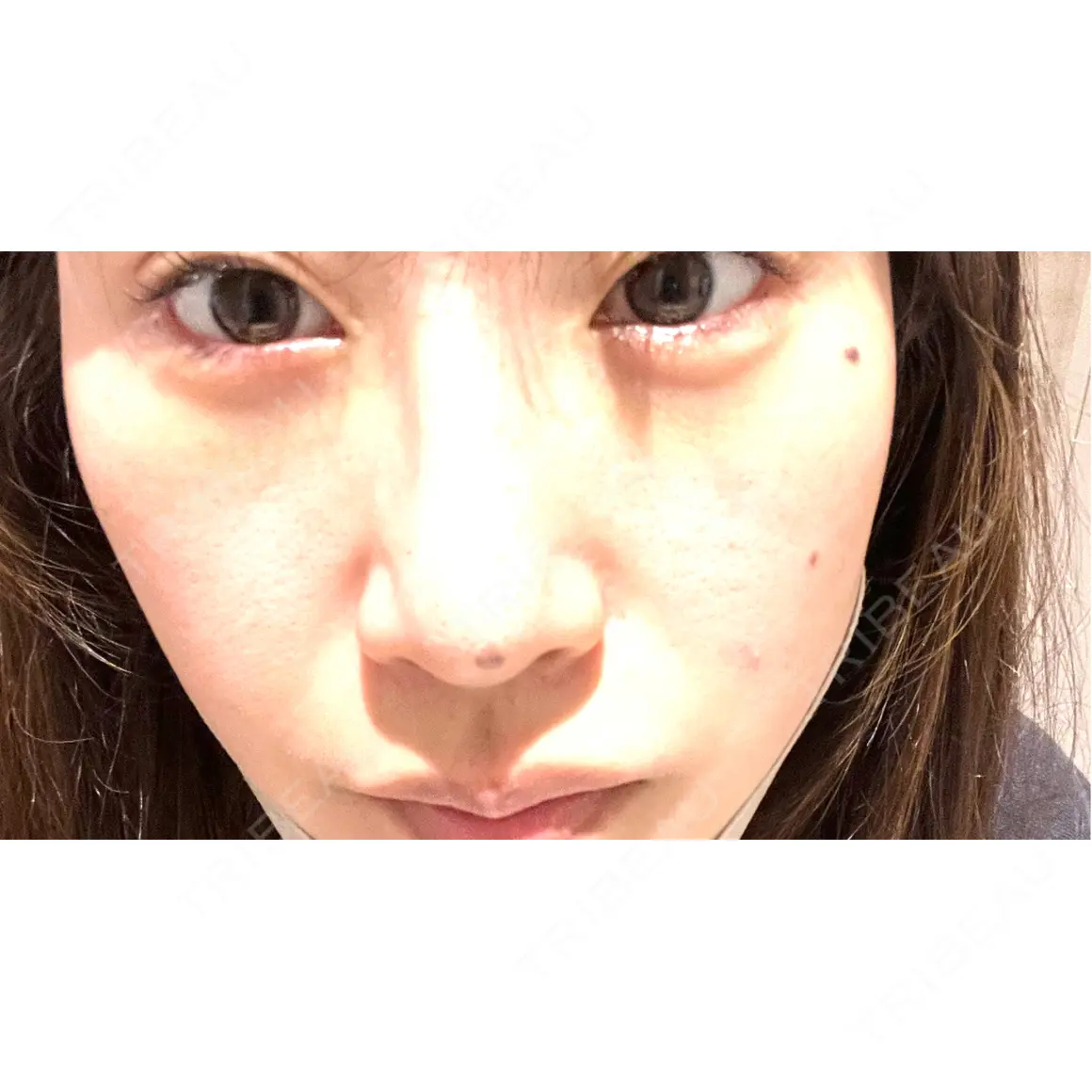 下まぶたの脂肪取り 銀座みゆき通り美容外科 大阪梅田院 DAY 0