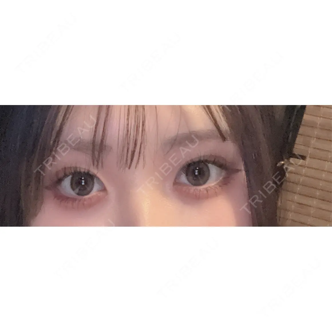 目頭切開 シンデレラ＆ダヴィンチクリニック AFTER