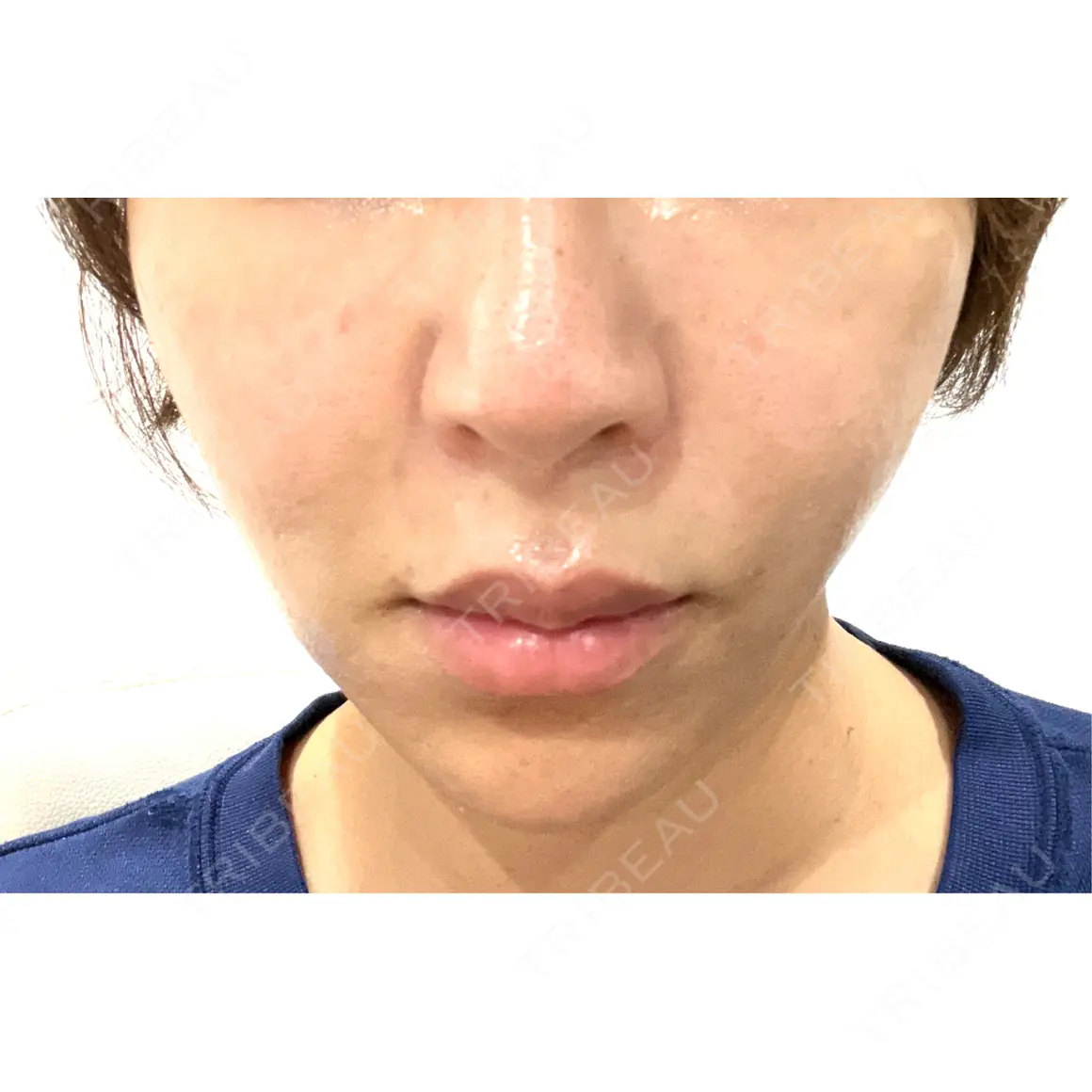 イオン導入 / ルメッカ Grias clinic （ジリアスクリニック） AFTER