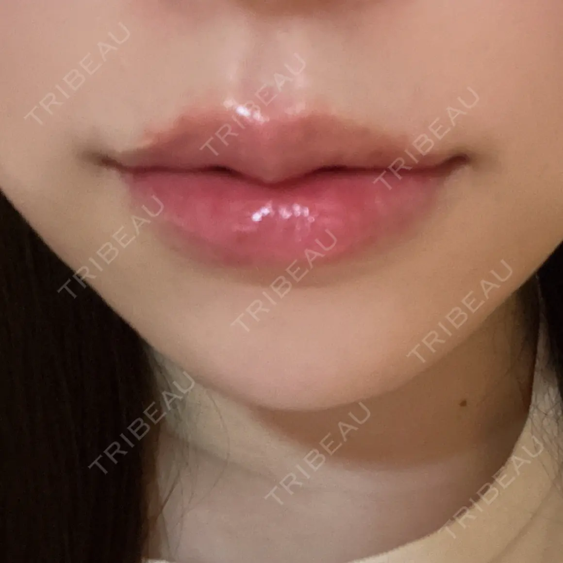 ヒアルロン酸注入（唇） AZ BEAUTY CLINIC DAY 0
