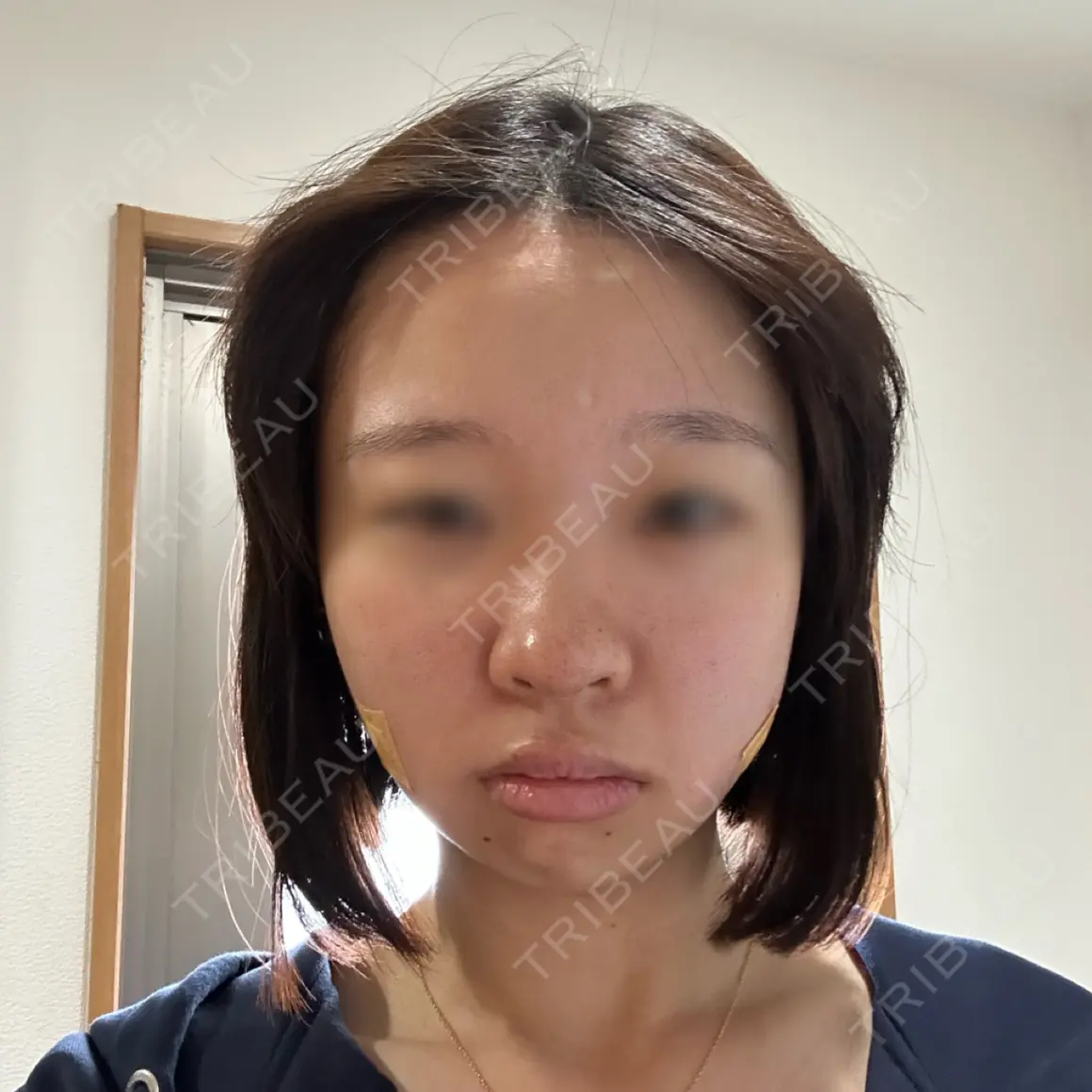 鼻尖形成（切開） / 脂肪吸引（顔） ネビュラクリニック 京都院 DAY 0