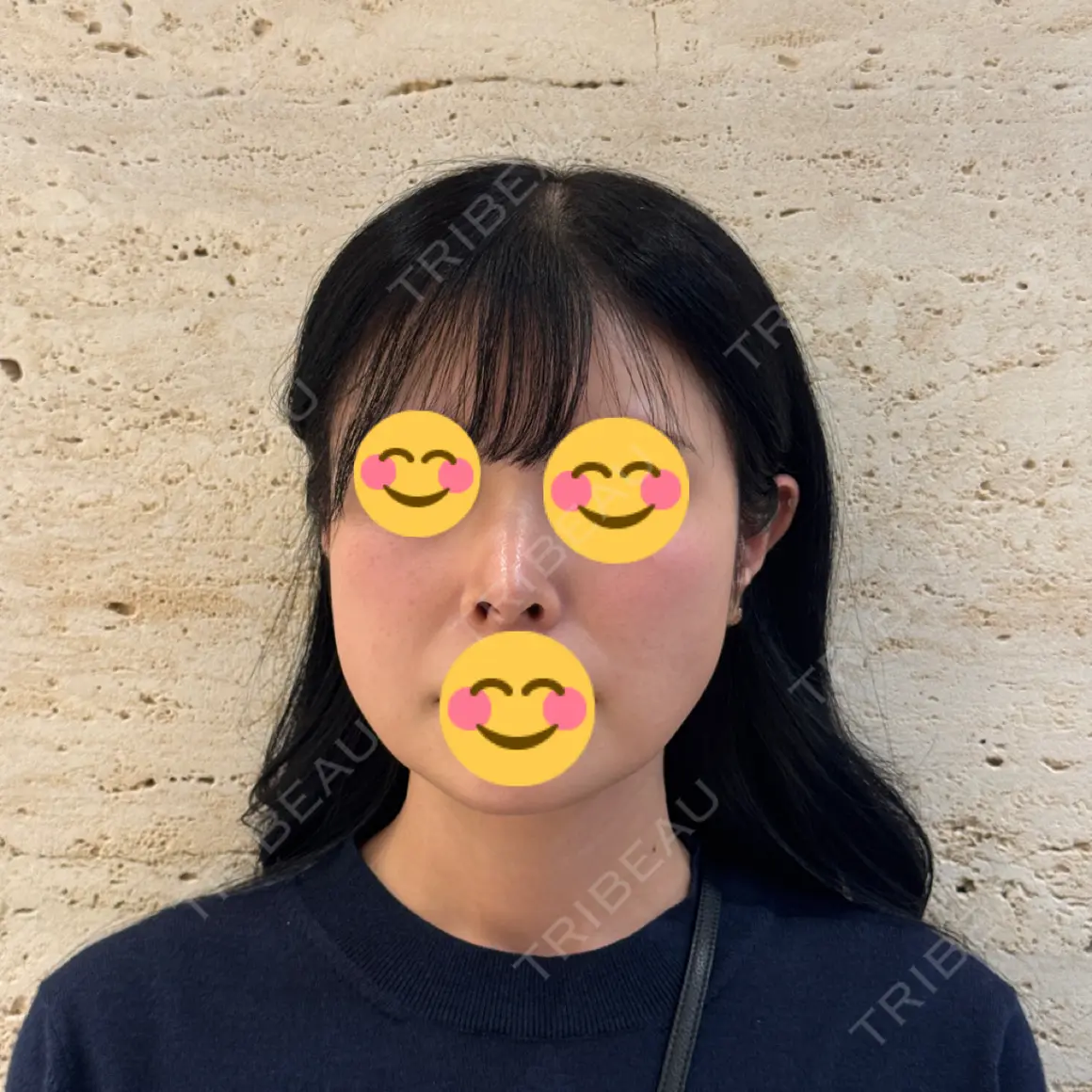 鼻尖形成（切開） / 脂肪吸引（顔） / 鼻孔縁下降 / あご下筋肉縛り / その他（鼻） LUHO（ルホ）美容外科 AFTER