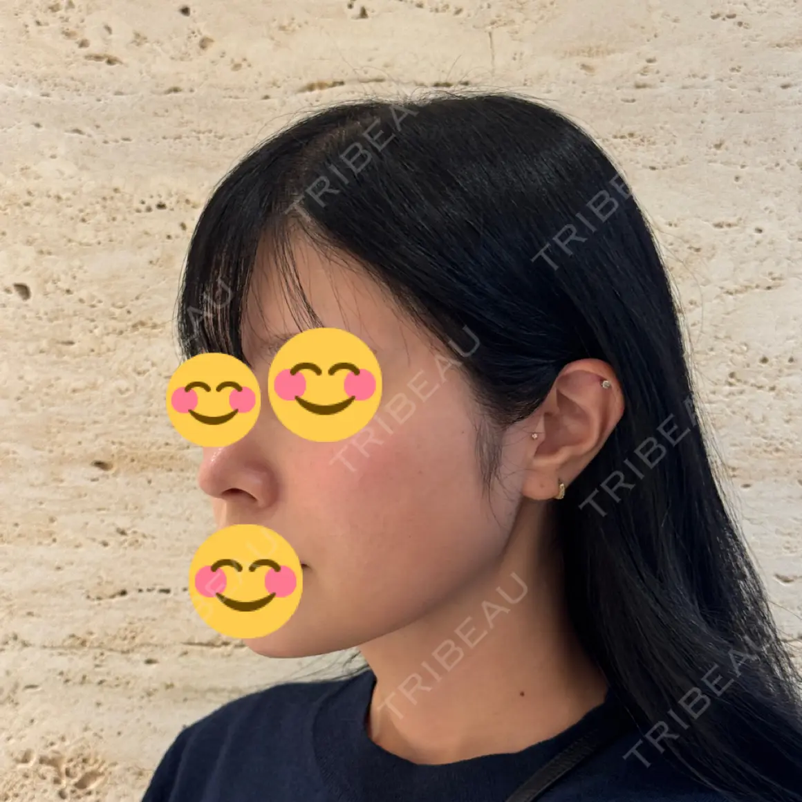 鼻尖形成（切開） / 脂肪吸引（顔） / 鼻孔縁下降 / あご下筋肉縛り / その他（鼻） LUHO（ルホ）美容外科 AFTER