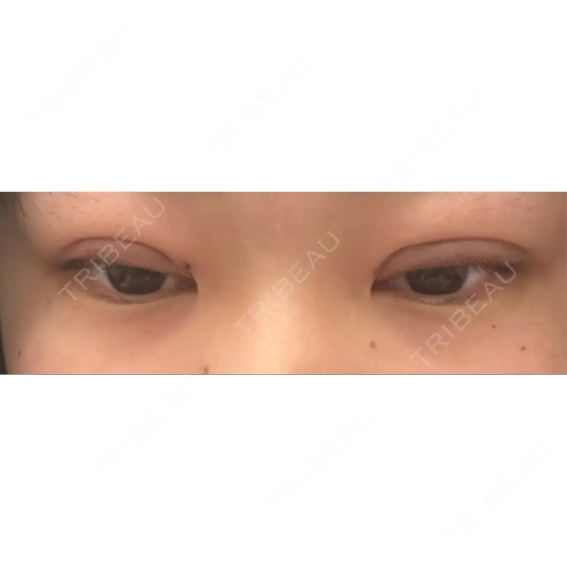 二重埋没 THE FIRST CLINIC 多摩センター院 DAY 0