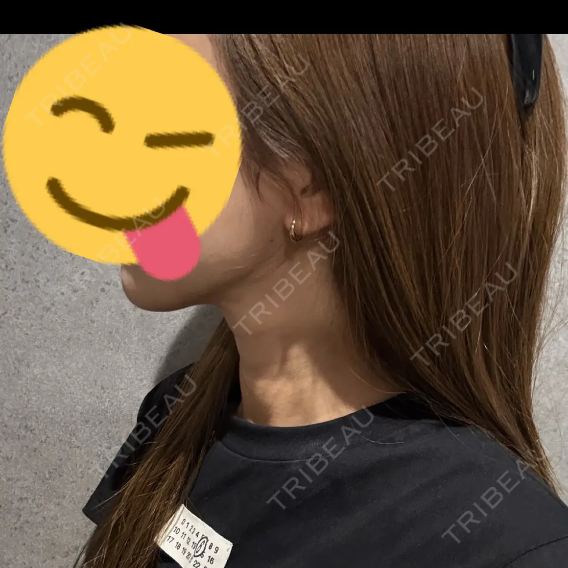 脂肪吸引（顔） Mods Clinic（モッズクリニック） 大阪院 AFTER