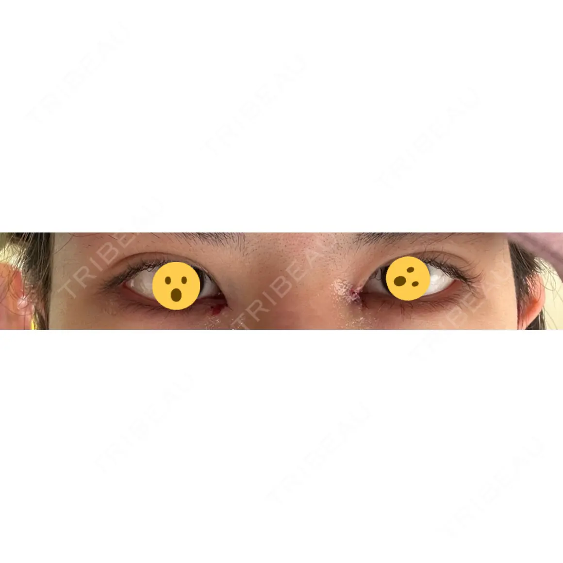 目頭切開 9BeautyClinic DAY 0