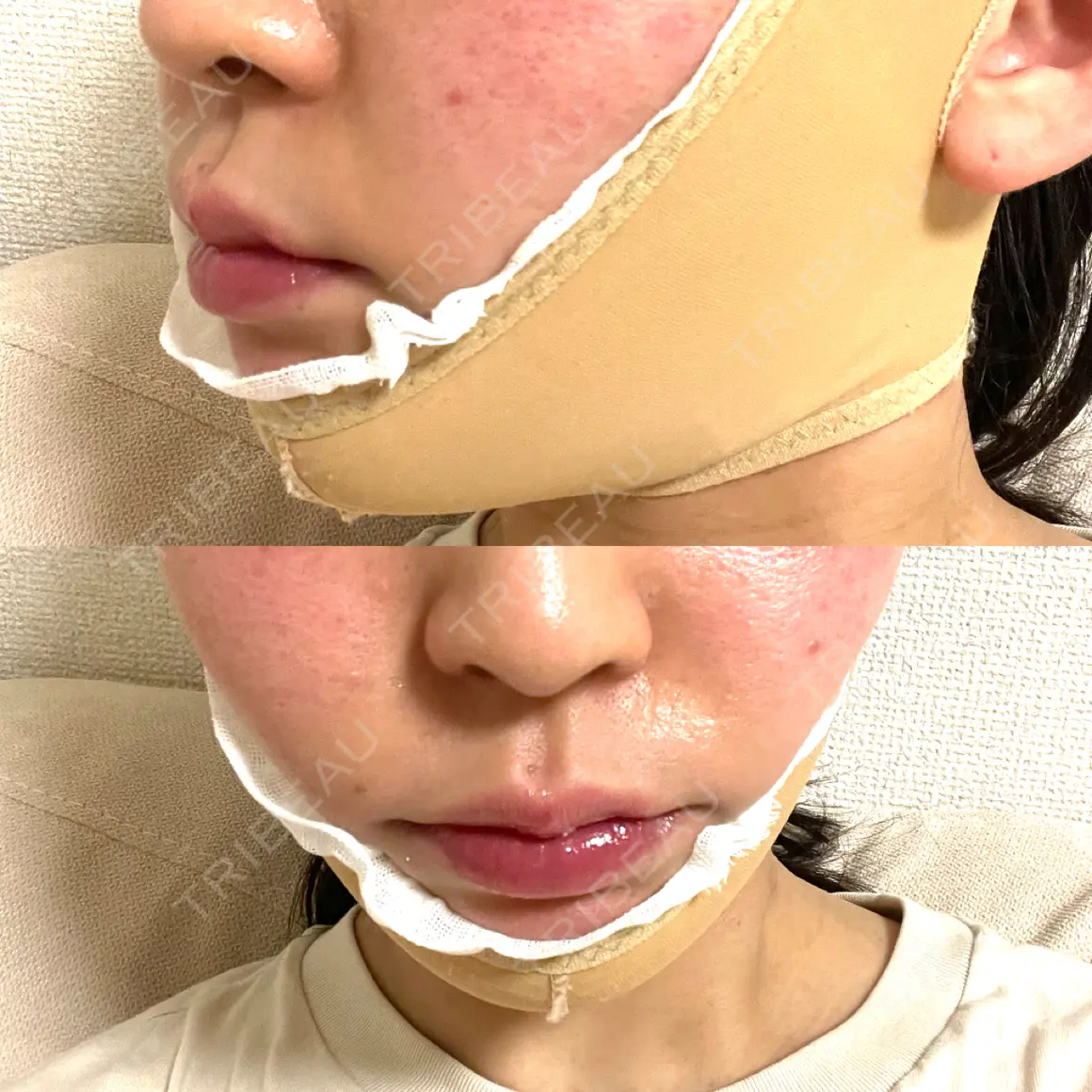 糸リフト / 脂肪吸引（顔） / 脂肪吸引注射（顔） ziz CLINIC DAY 0