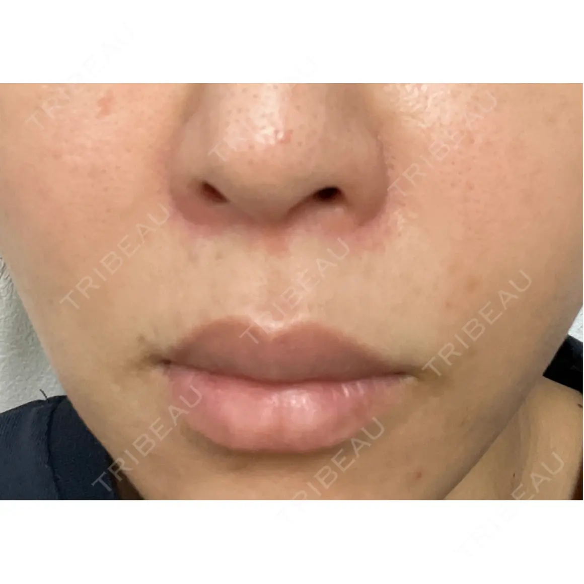 イオン導入 / ルメッカ Grias clinic （ジリアスクリニック） AFTER