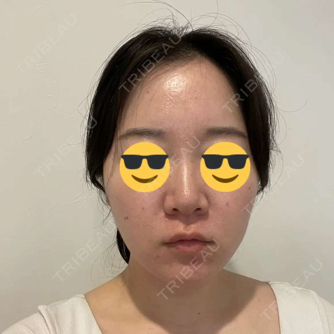脂肪吸引（顔） Mods Clinic（モッズクリニック） 大阪院 AFTER