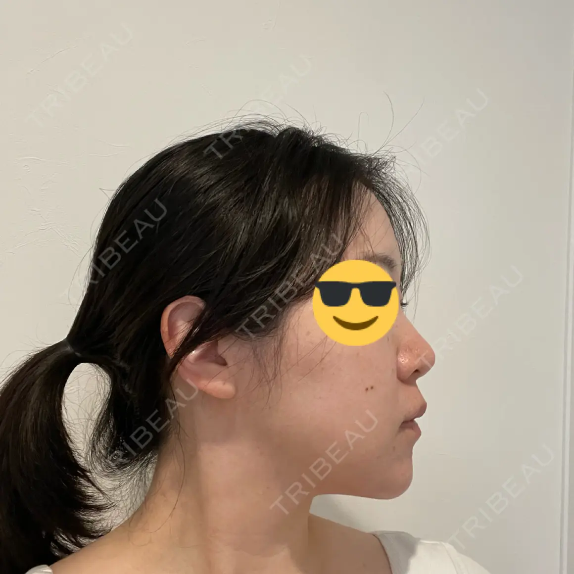 脂肪吸引（顔） Mods Clinic（モッズクリニック） 大阪院 AFTER