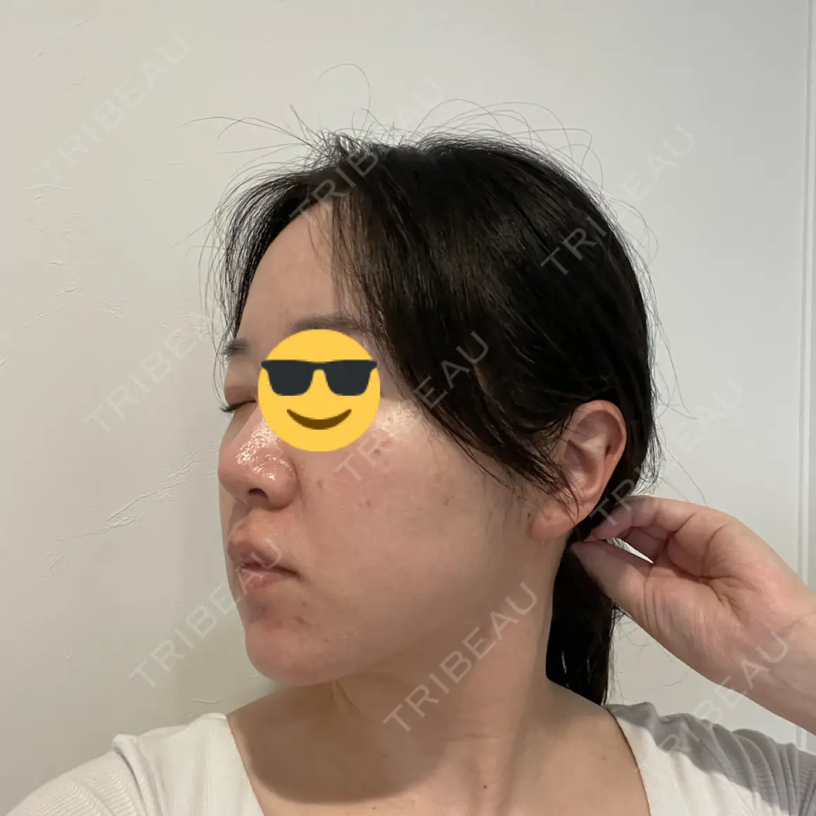 脂肪吸引（顔） Mods Clinic（モッズクリニック） 大阪院 AFTER