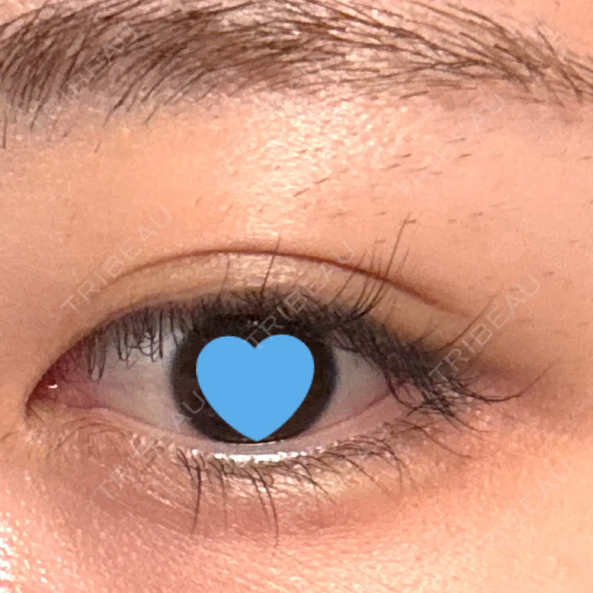 ヒアルロン酸注入（涙袋） フィラークリニック 渋谷院 AFTER