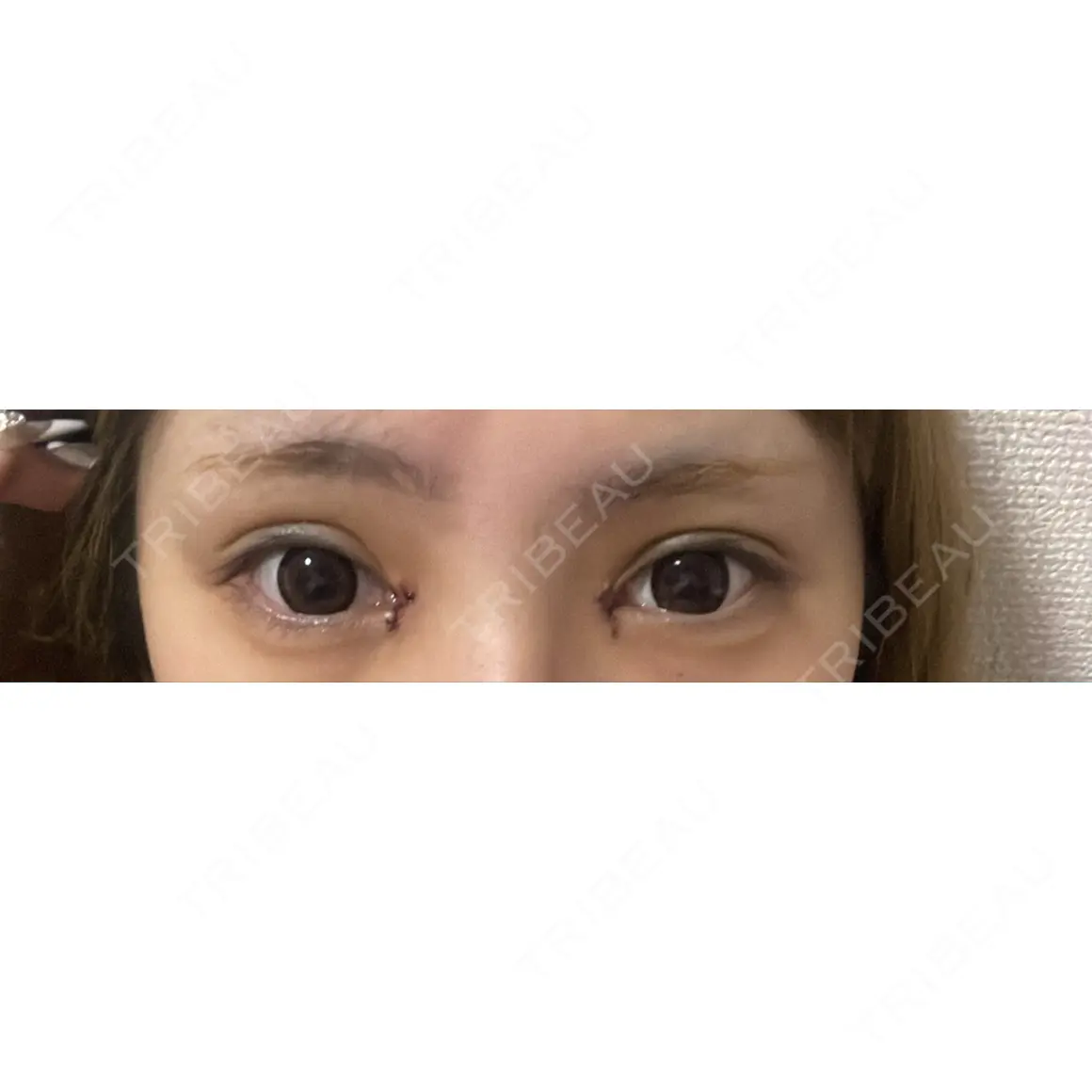 目頭切開 PRO CLINIC プロクリニック 銀座院 AFTER