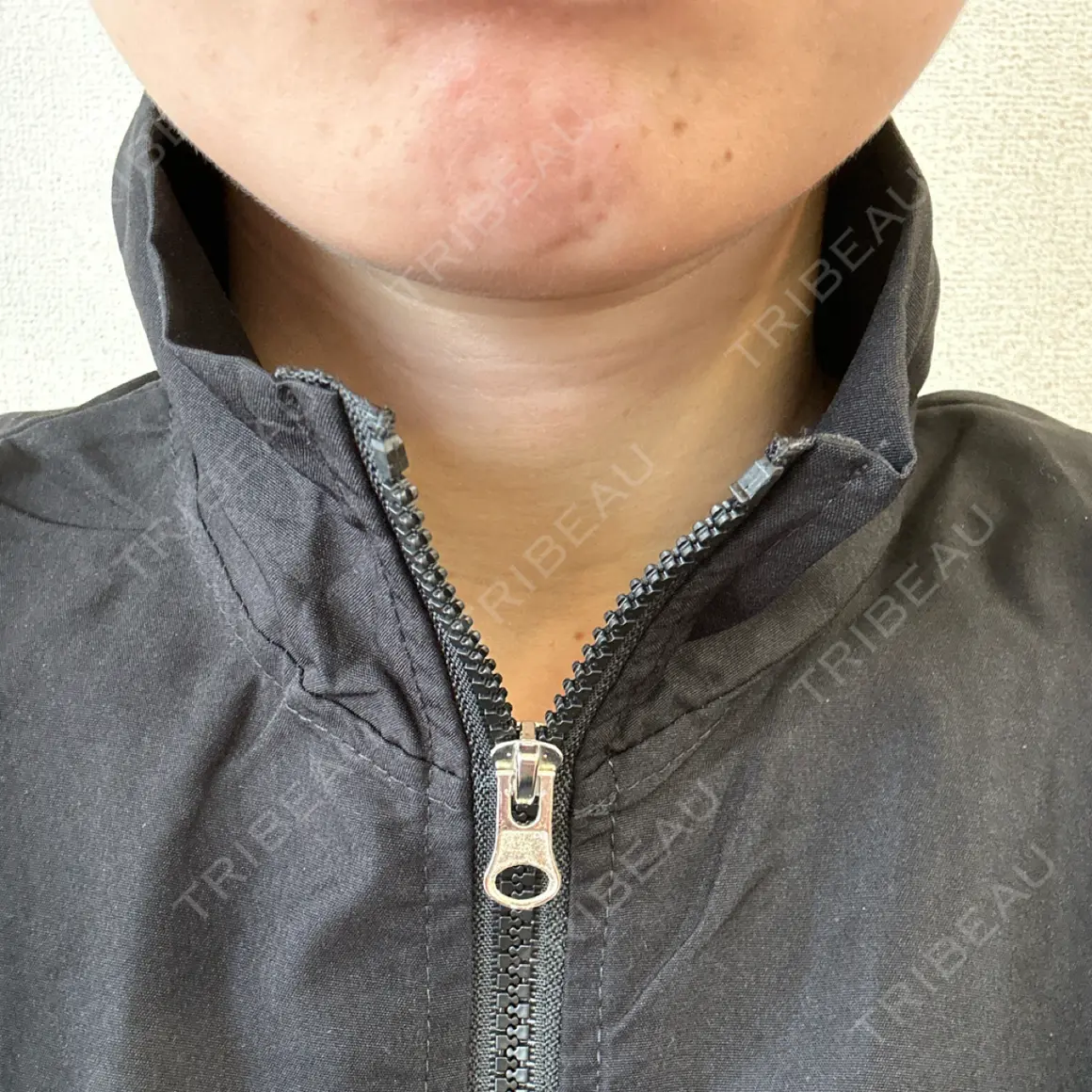 ボトックス（エラ・小顔） eクリニック 金沢本院 DAY 0