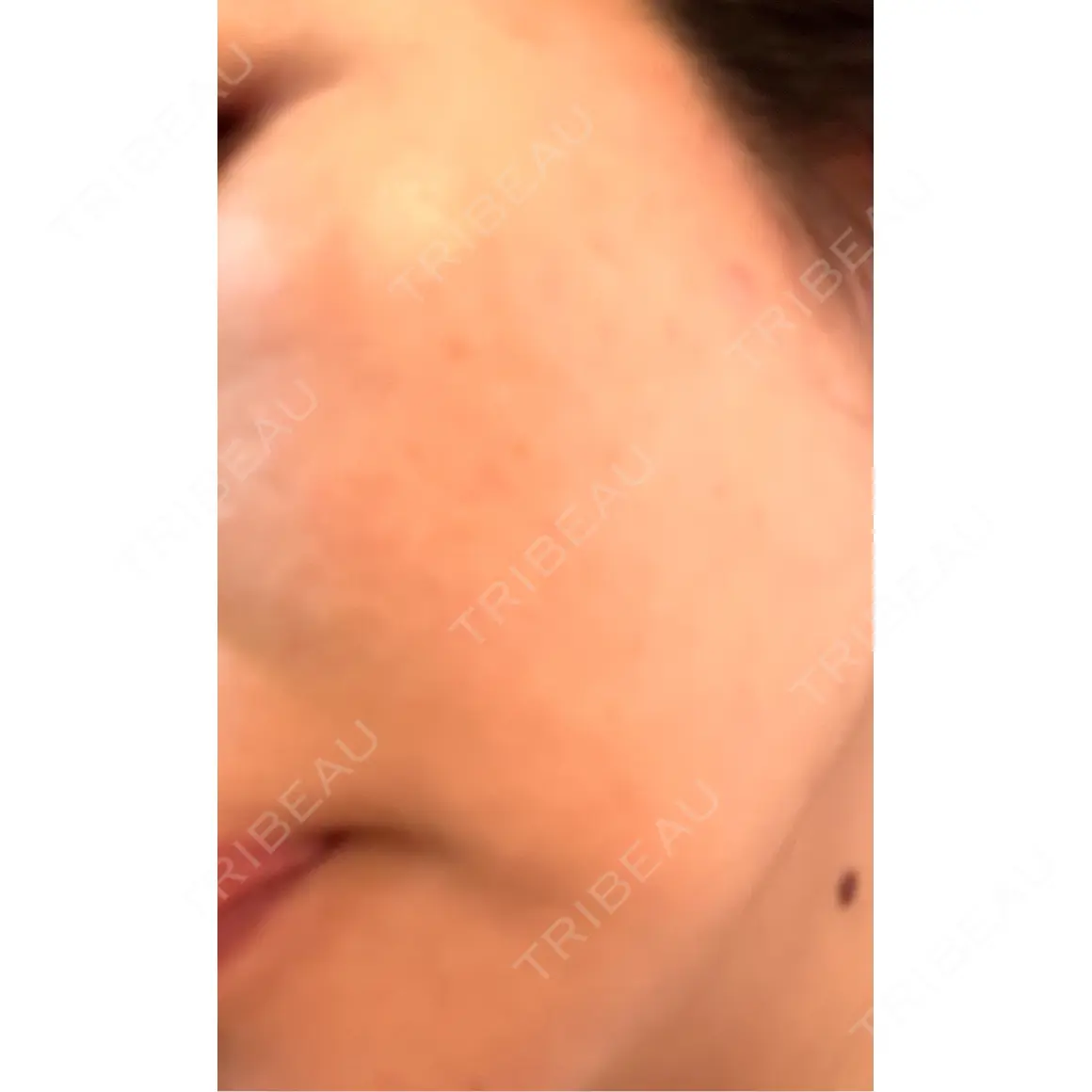 ルビーレーザー AZ BEAUTY CLINIC AFTER