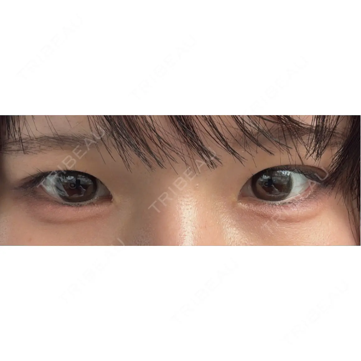 ヒアルロン酸注入（涙袋） フィラークリニック 福岡院 AFTER