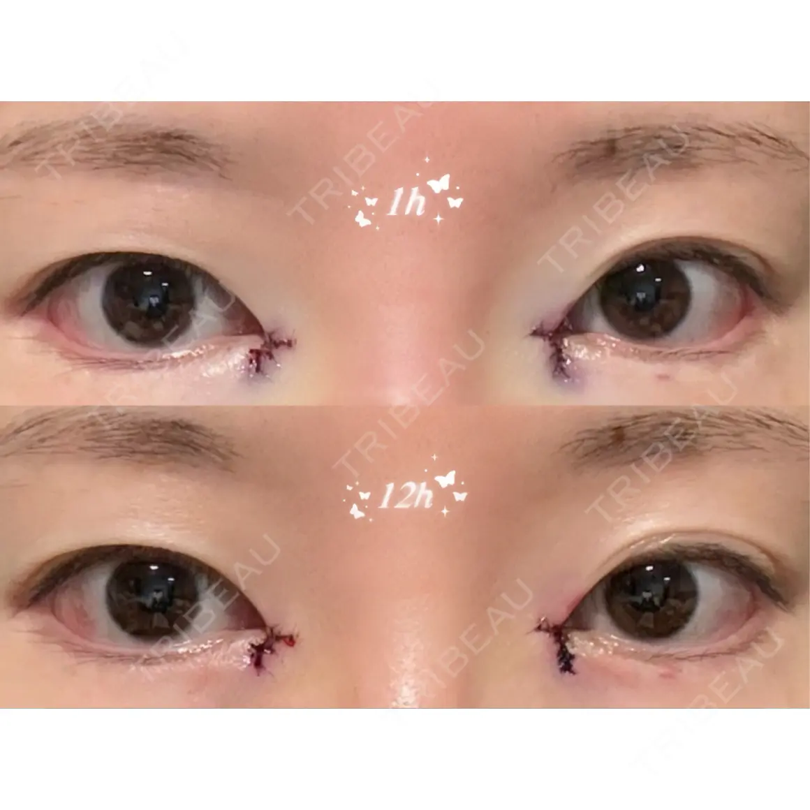 蒙古ひだ形成 銀座マイアミ美容外科 DAY 0