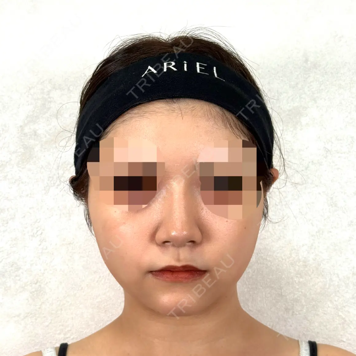 ヒアルロン酸注入（鼻） / ヒアルロン酸注入（あご） アリエル美容クリニック 横浜院 AFTER