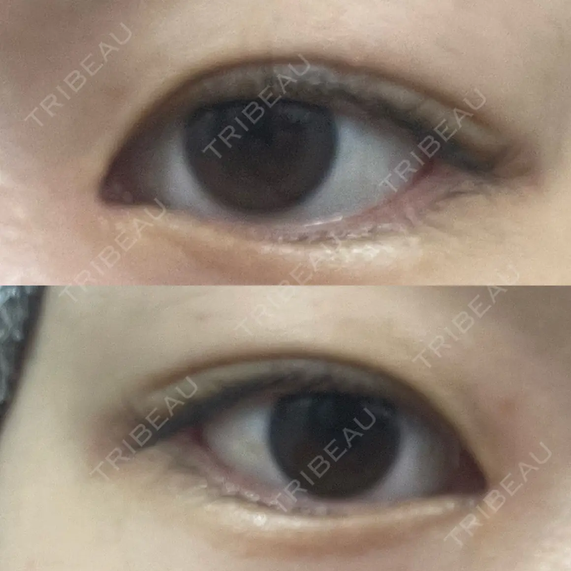 目頭切開 9BeautyClinic AFTER