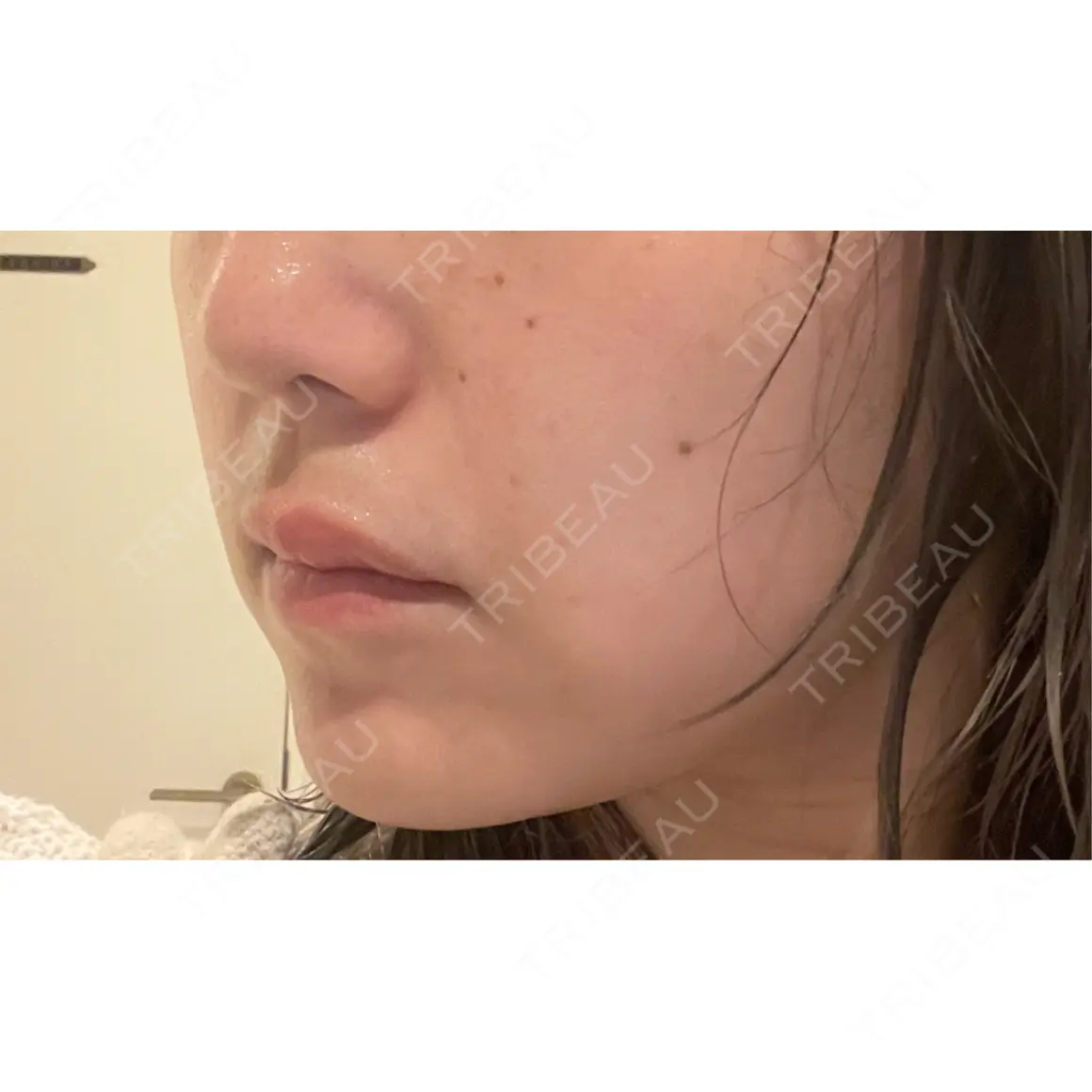 ボトックス（あご） / ボトックス（エラ・小顔） / 脂肪溶解注射（顔） / ボトックス（人中） Kinshicho Beauty Clinic （錦糸町ビューティークリニック） AFTER