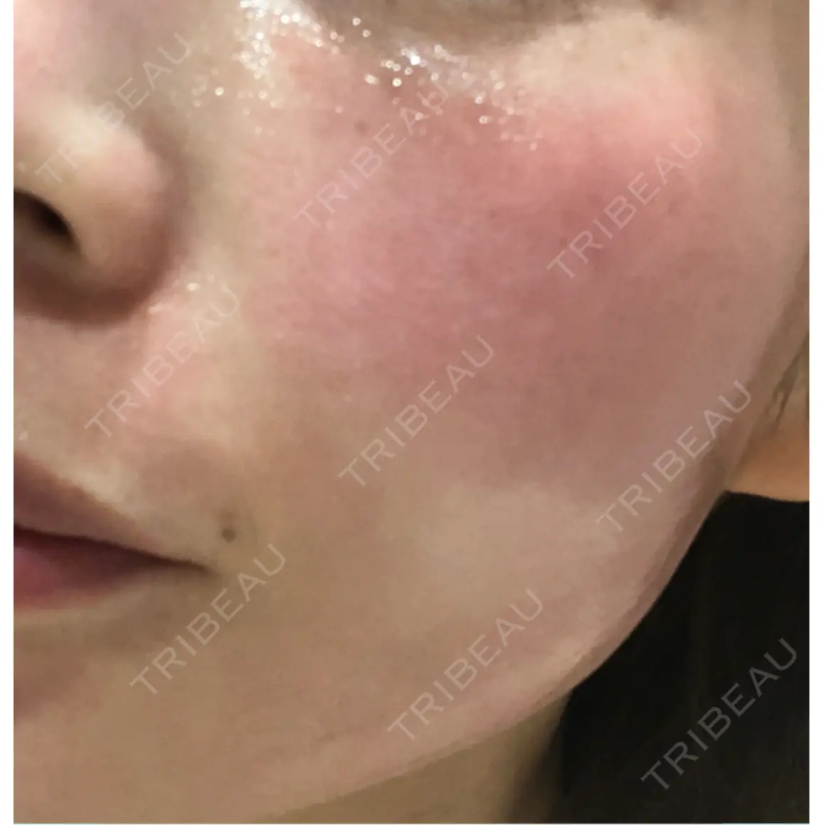 ニードルRF（ポテンツァなど） Ledian Clinic六本木 DAY 0