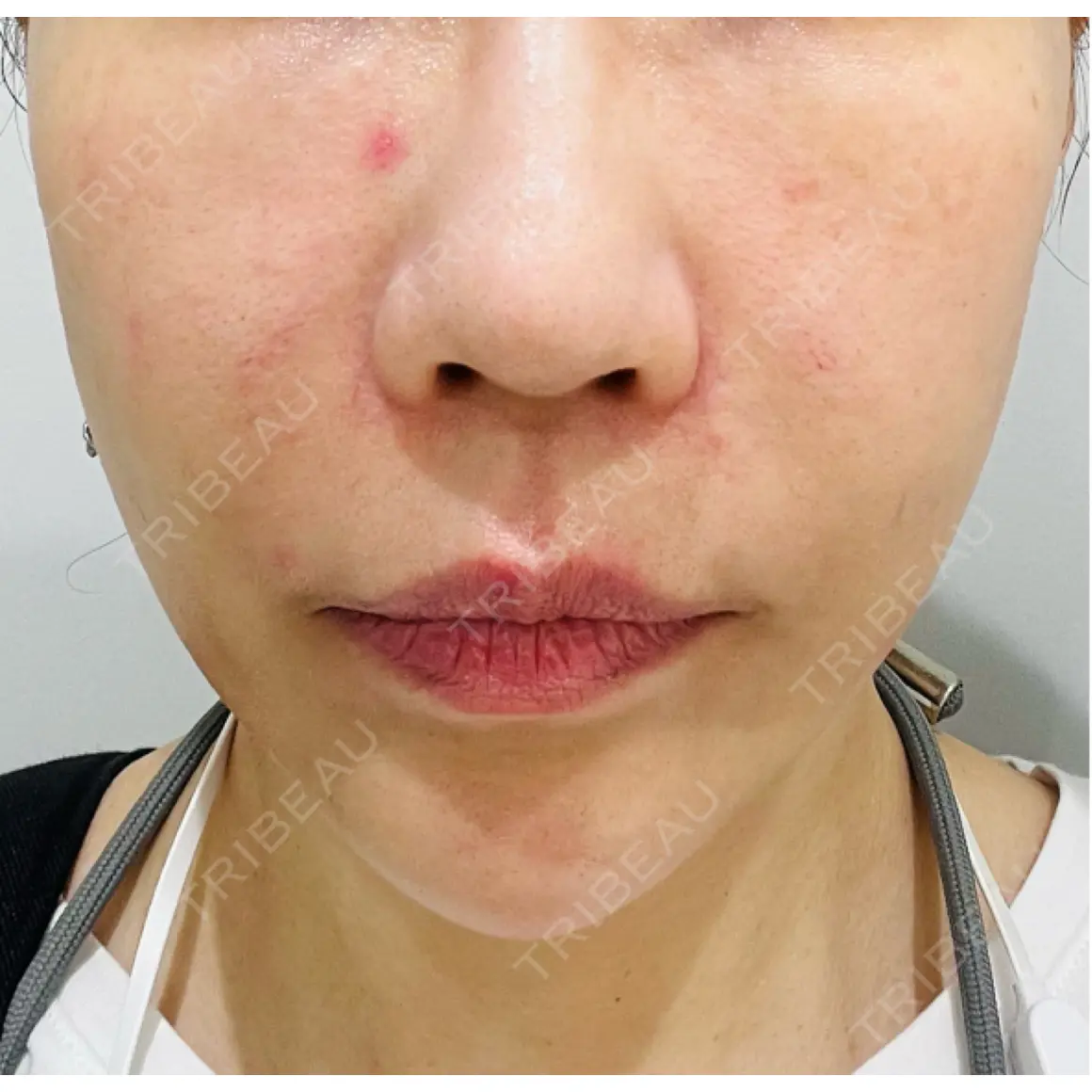 ハイフ（顔） WellnessPlus Clinic 【ウェルネスプラスクリニック】 DAY 0