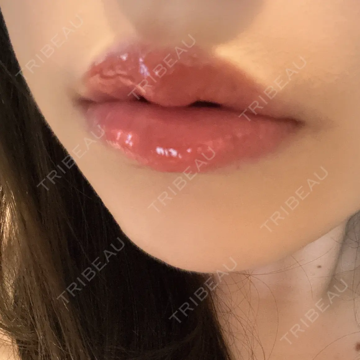 ヒアルロン酸注入（唇） AZ BEAUTY CLINIC AFTER