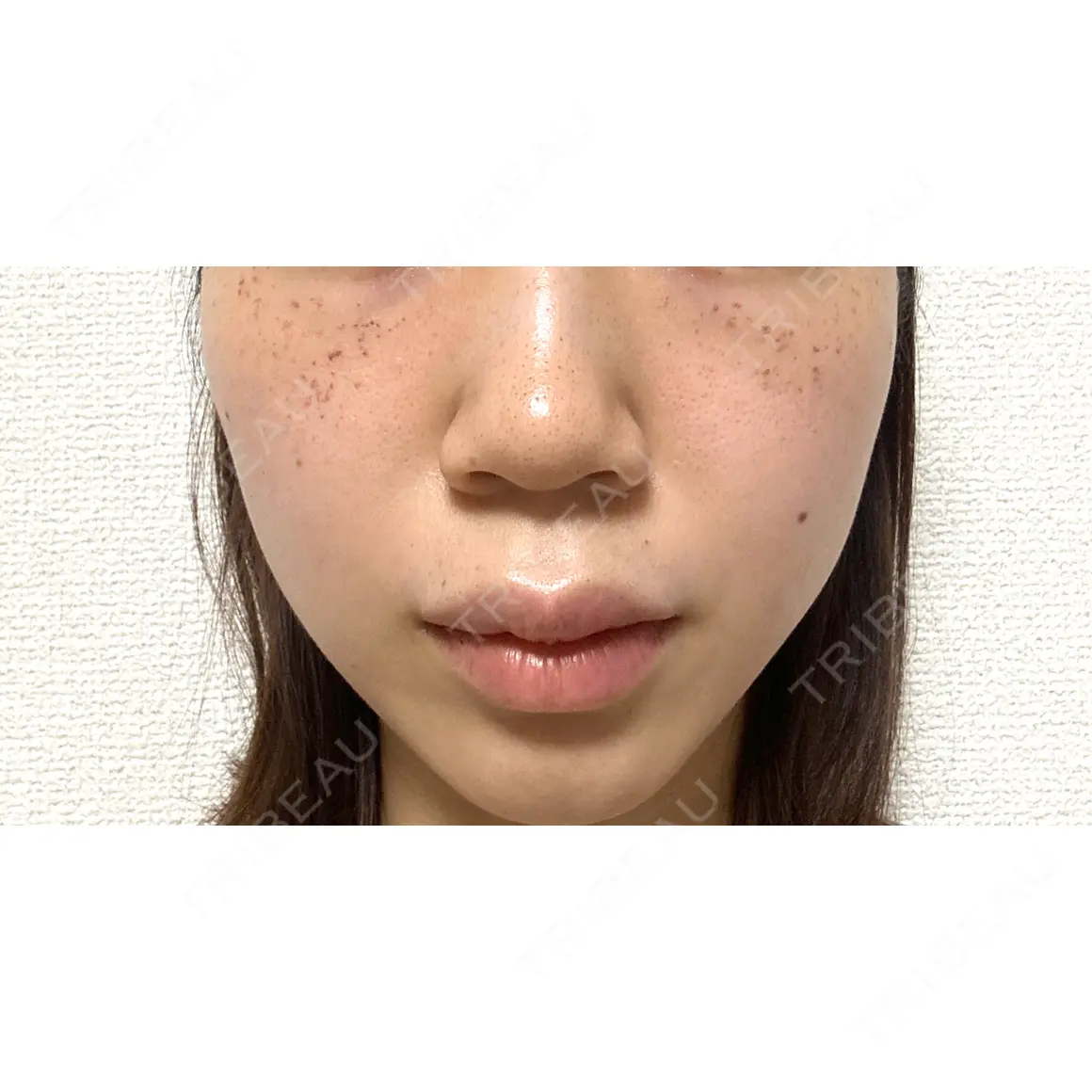 毛穴洗浄（ハイドラフェイシャルなど） / ルメッカ CZEN CLINIC 銀座院 DAY 0