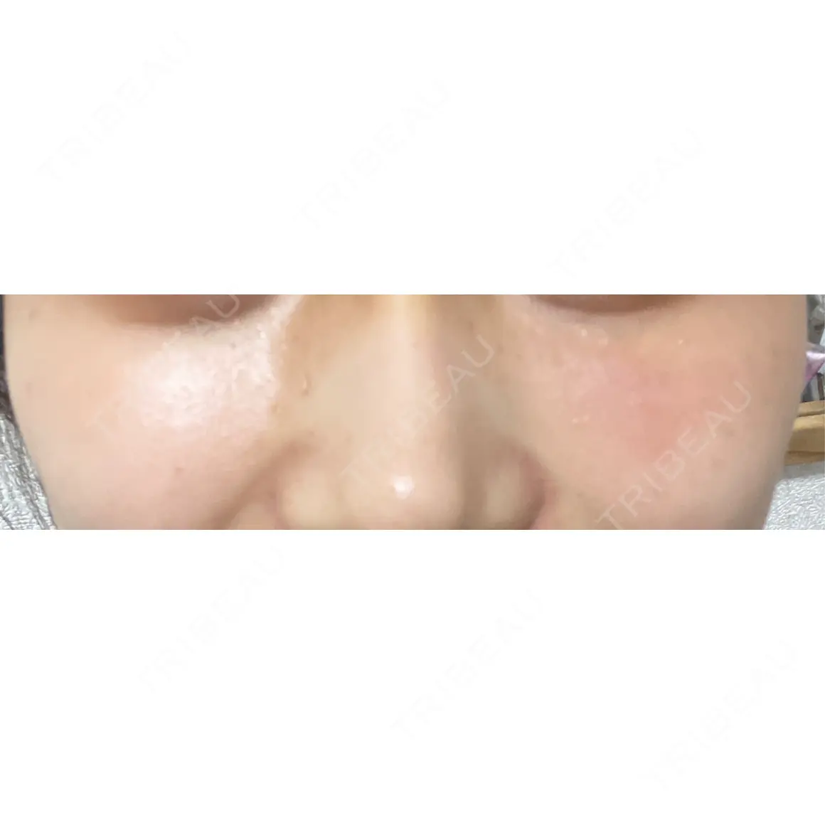 ハイフ（顔） A CLINIC（エークリニック） 福岡院 AFTER