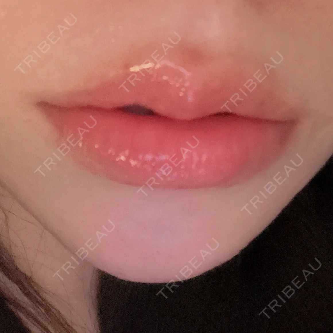 ヒアルロン酸注入（唇） AZ BEAUTY CLINIC AFTER