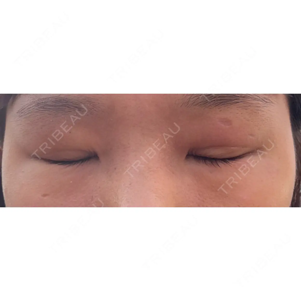二重埋没 NARU Beauty Clinic 【ナルクリ】 AFTER