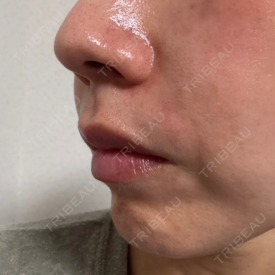 ヒアルロン酸注入（頬） / ボトックス（目尻） / その他（口元） フィラークリニック 福岡院 DAY 1