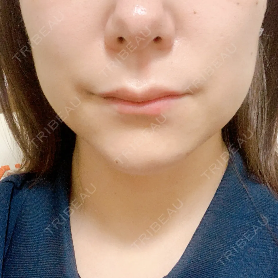 ハイフ（顔） しんゆり美容健康クリニック AFTER