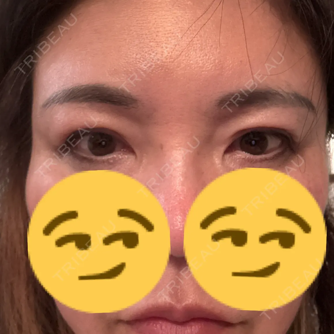 二重埋没 / 目元修正 BELINDA CLINIC（ベリンダクリニック）岡山院 AFTER