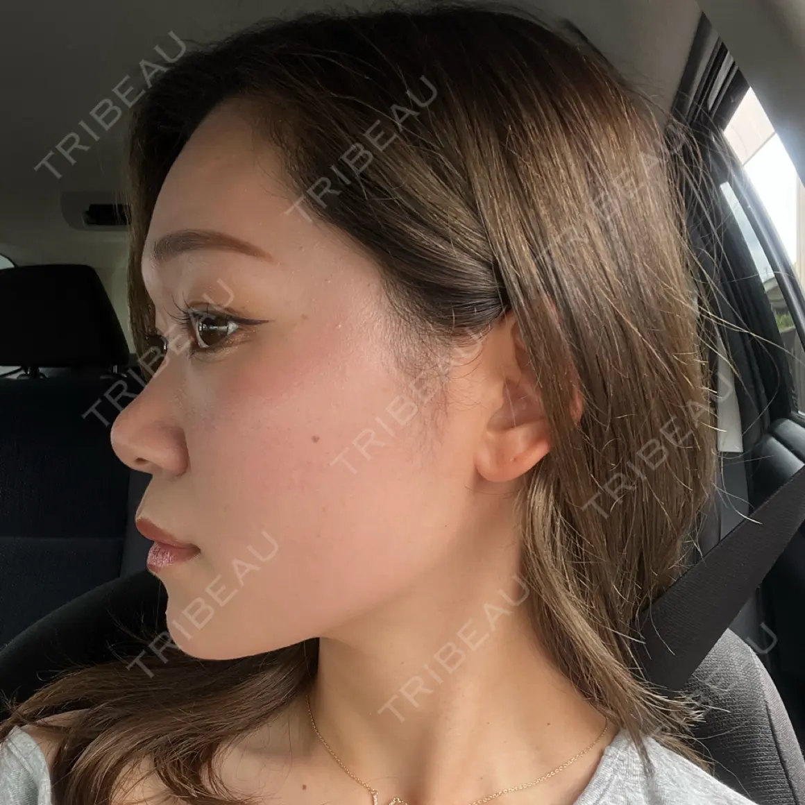 ボトックス（エラ・小顔） ルラ美容クリニック 大阪心斎橋院 AFTER