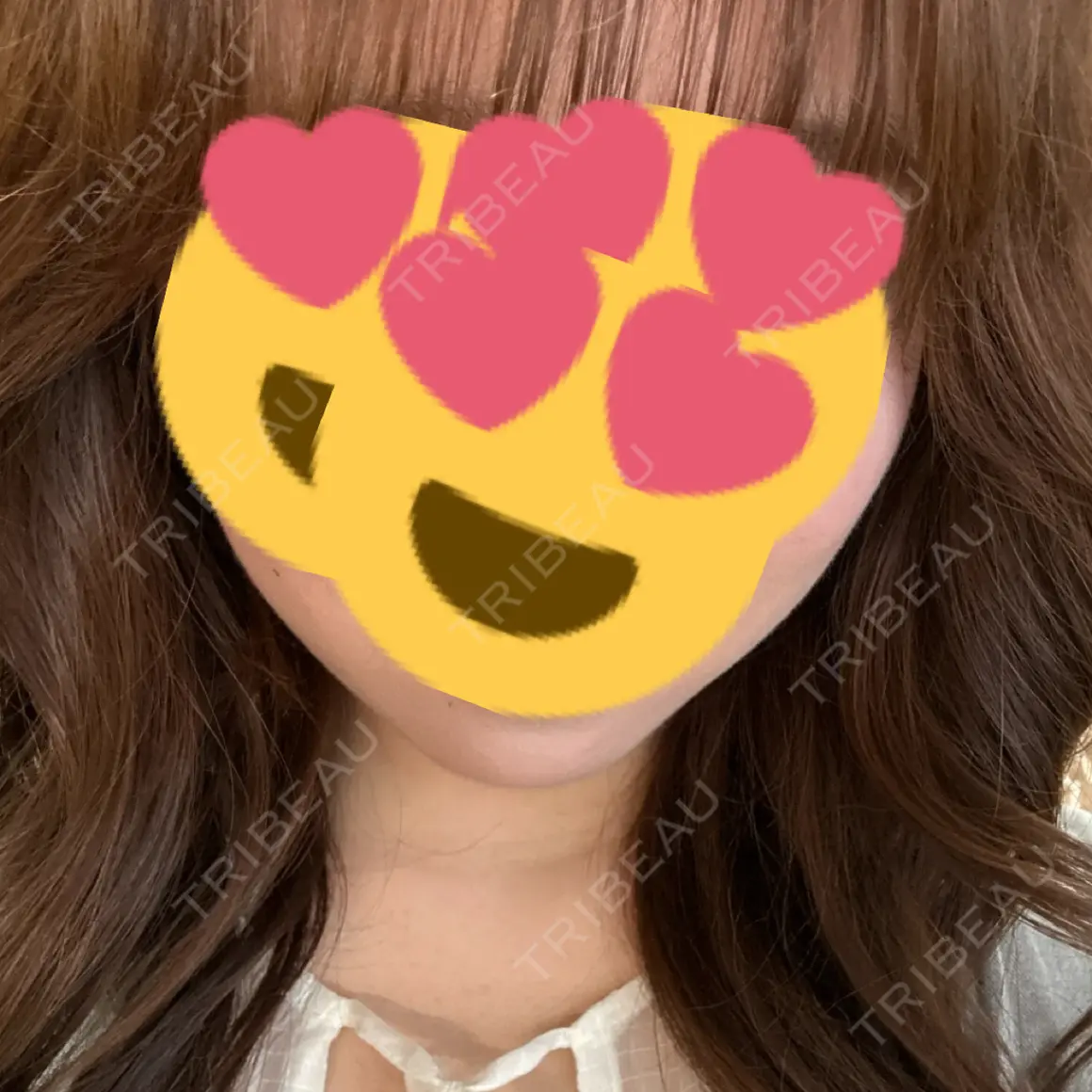ボトックス（額） TCB東京中央美容外科 草津院 AFTER