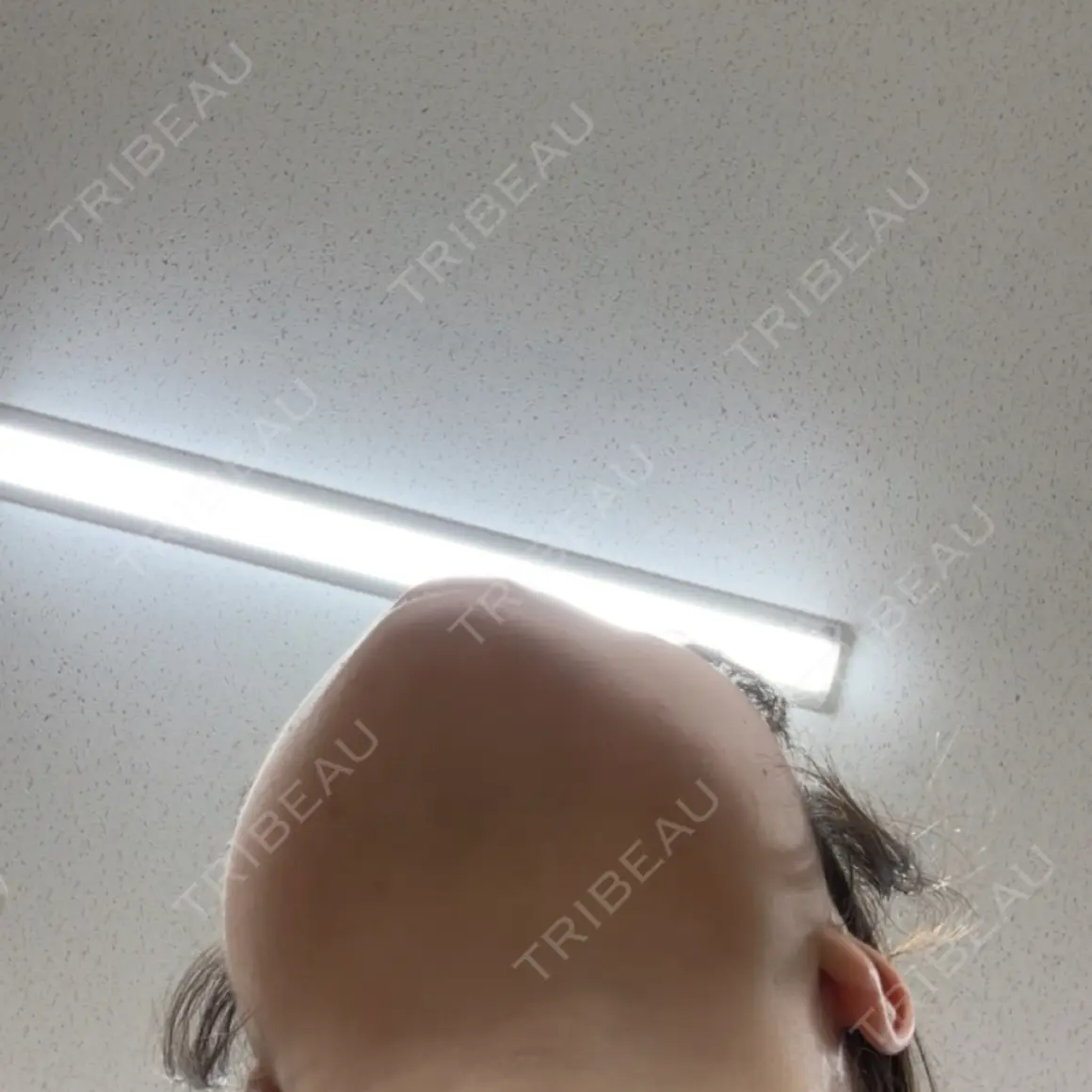 ボトックス（額） TCB東京中央美容外科 草津院 AFTER