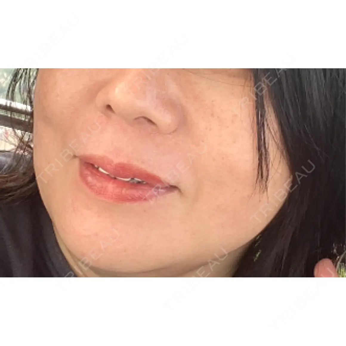 ヒアルロン酸注入（鼻翼基部） TCB東京中央美容外科 京都四条院 AFTER