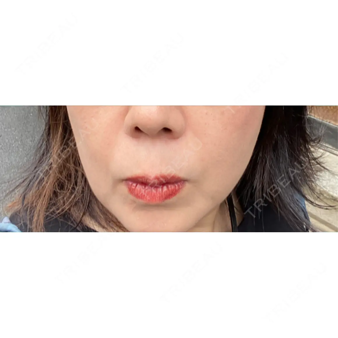 ヒアルロン酸注入（鼻翼基部） TCB東京中央美容外科 京都四条院 AFTER