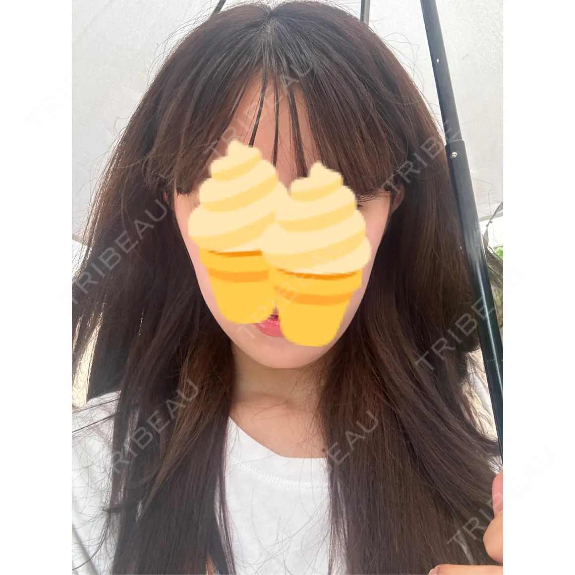 ボトックス（エラ・小顔） TCB東京中央美容外科 金山院 AFTER