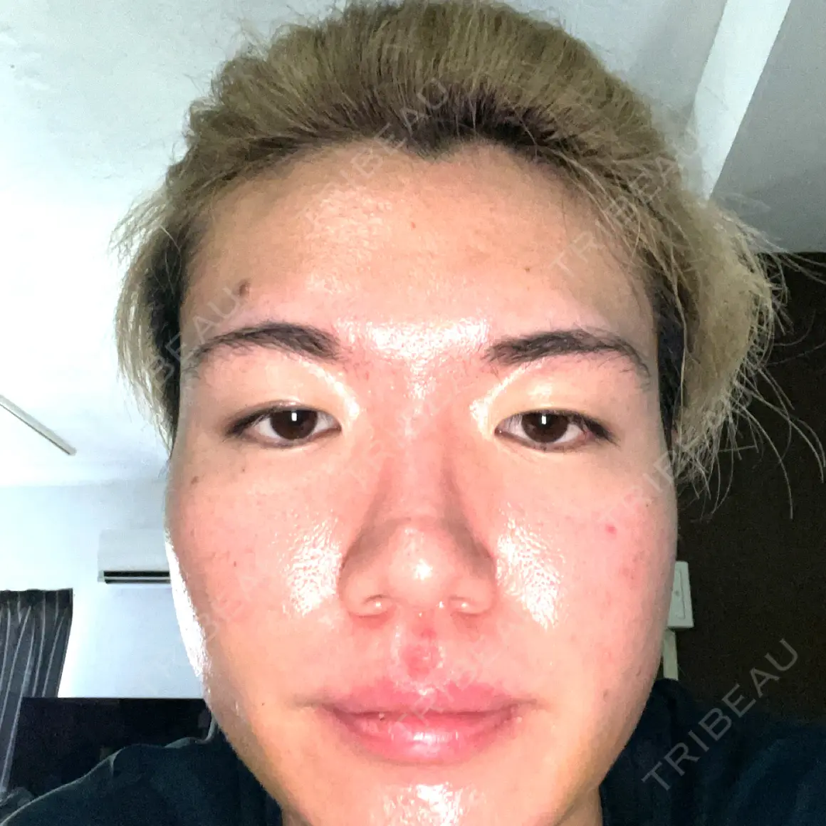 糸リフト / 脂肪吸引（顔） / ボトックス（エラ・小顔） MEMOTO CLINIC 名古屋 DAY 7