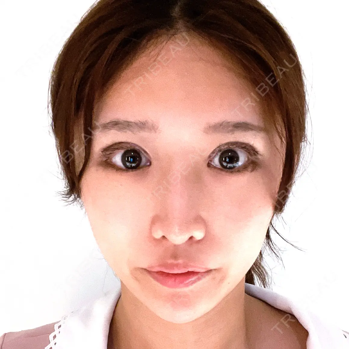 二重切開 / 眼瞼下垂（切開） / 上まぶたたるみ取り / 上まぶたの脂肪取り オーキッド美容クリニック東京御徒町 DAY 0