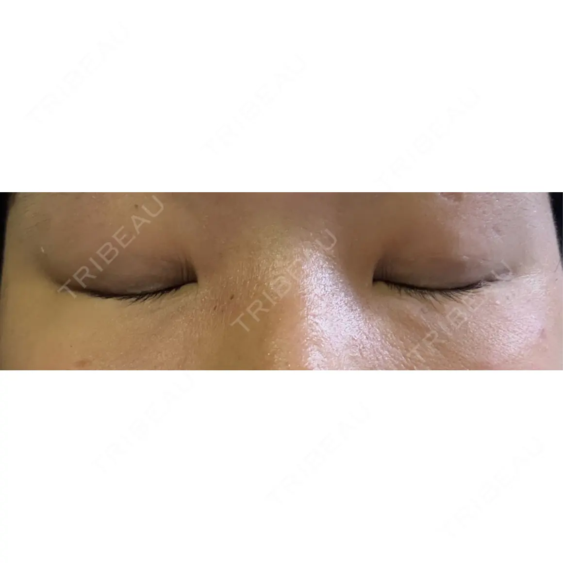二重埋没 NARU Beauty Clinic 【ナルクリ】 AFTER