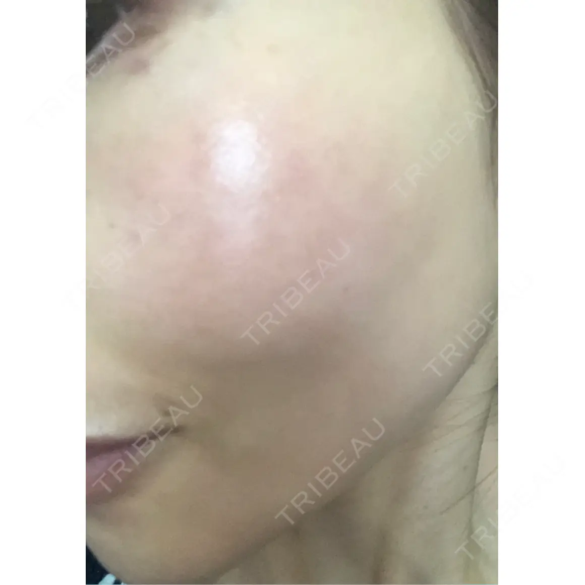 ニードルRF（ポテンツァなど） Ledian Clinic六本木 AFTER