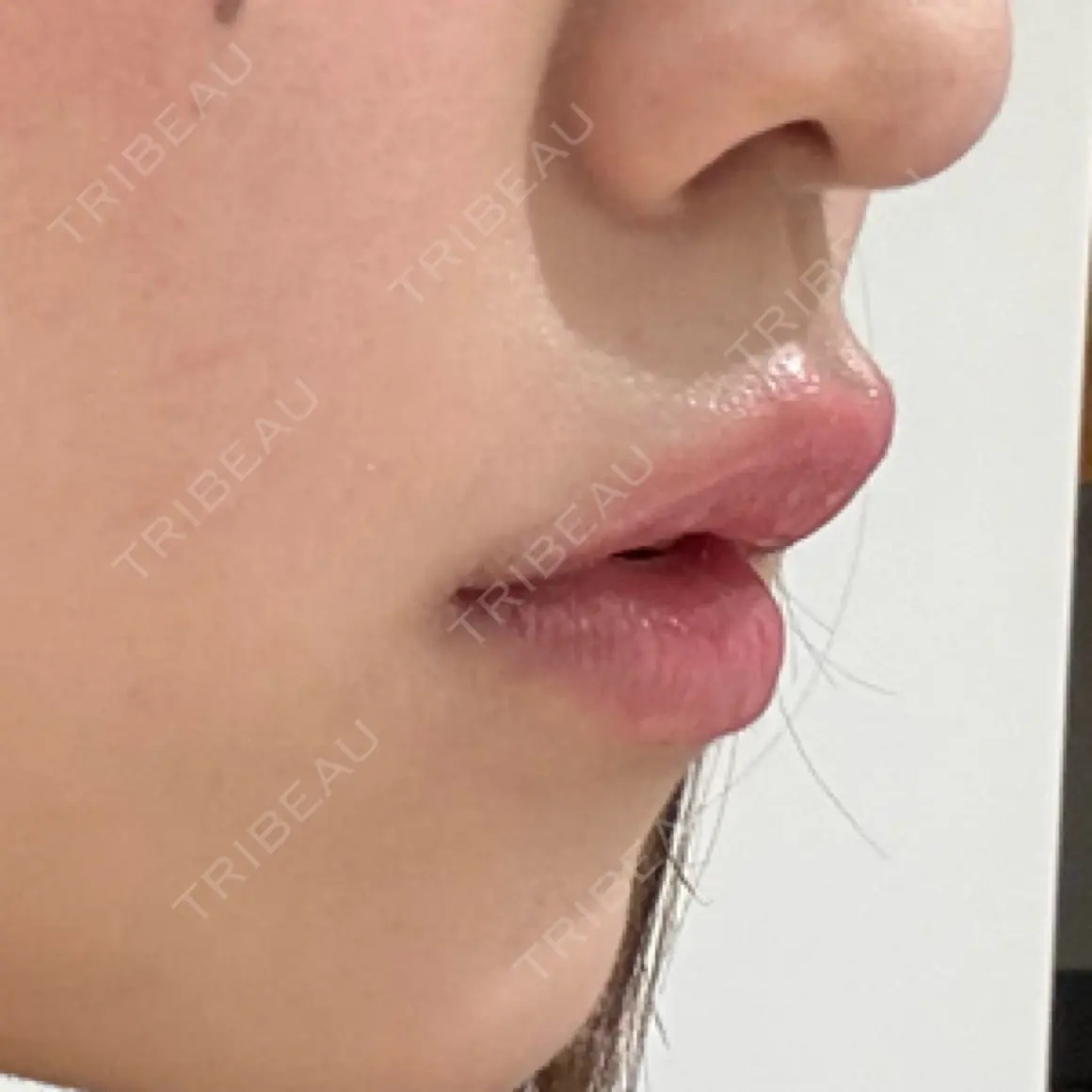 口角挙上 / ヒアルロン酸注入（唇） / その他（口元） 銀座美容外科クリニック 銀座院 AFTER