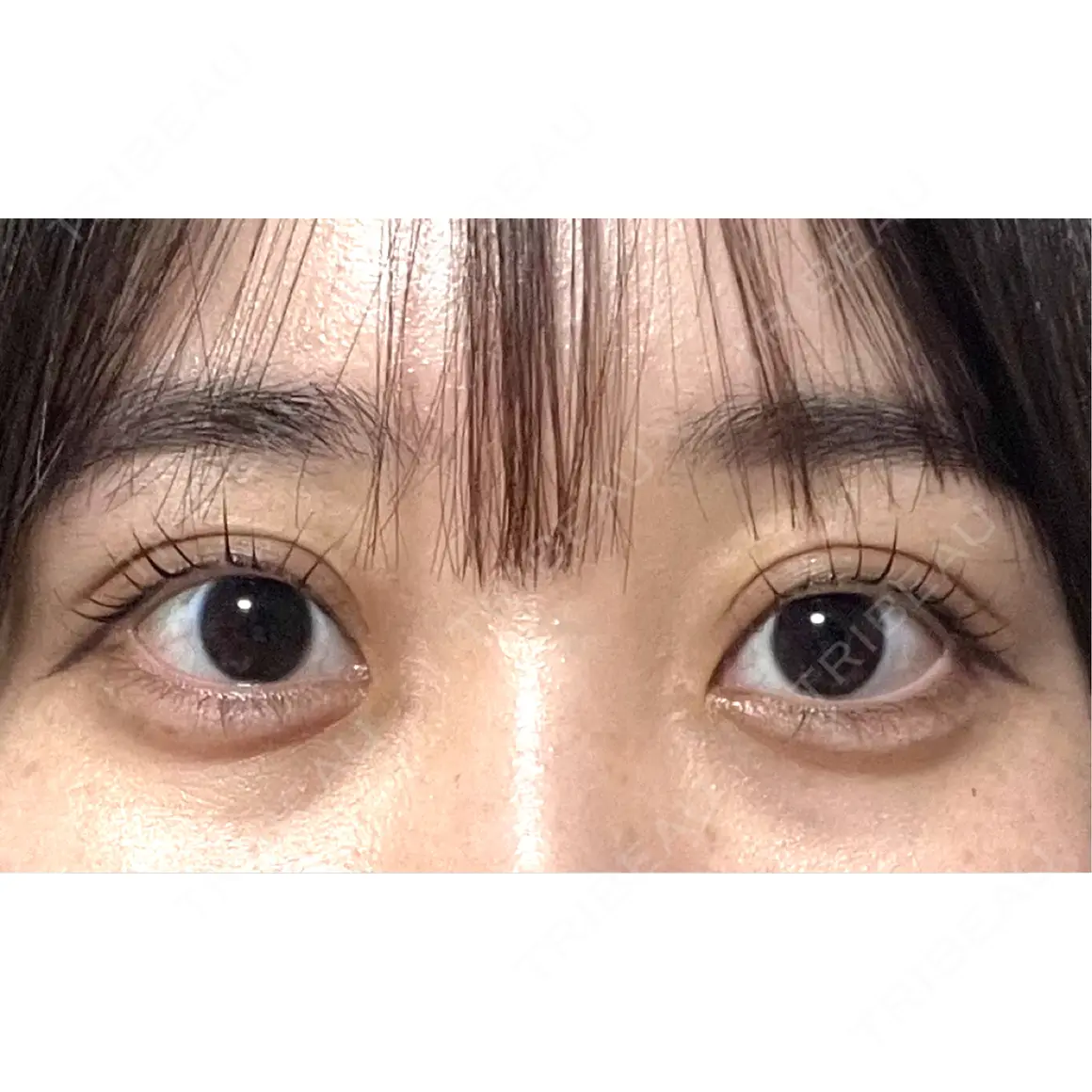 二重埋没 湘南美容クリニック 池袋東口院 AFTER